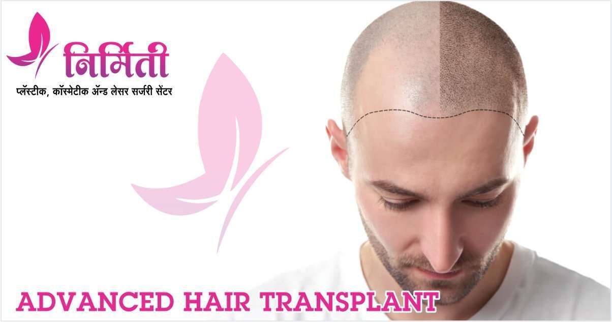 Advanced Hair Transplant Cost | Advanced Hair Restoration