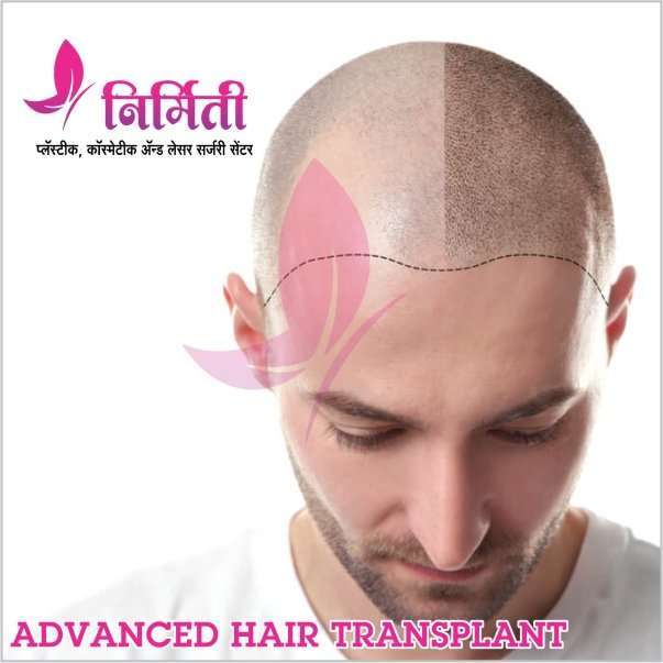 advanced-hair-transplant