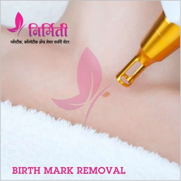 birth-mark-removal-treatment