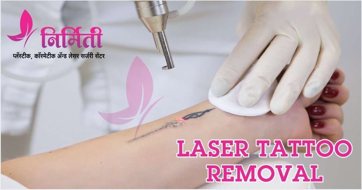 Permanent Tattoo Removal Treatment in Mumbai - Tattoo Removal in Andheri