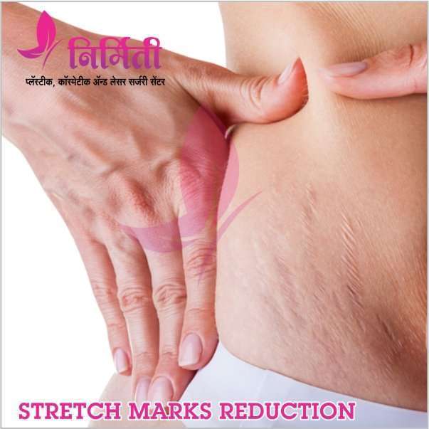 stretch-mark-reduction
