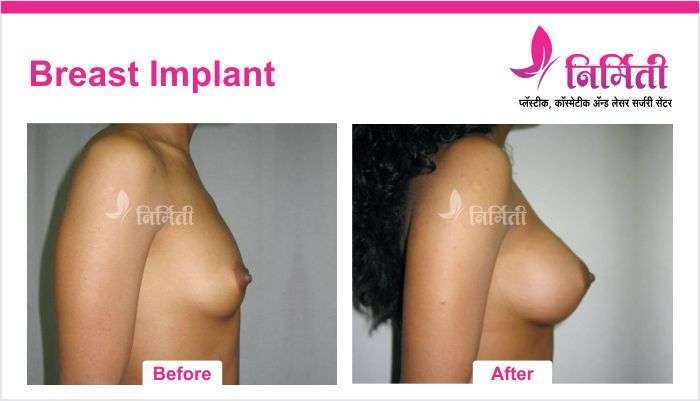 breast-implant-1