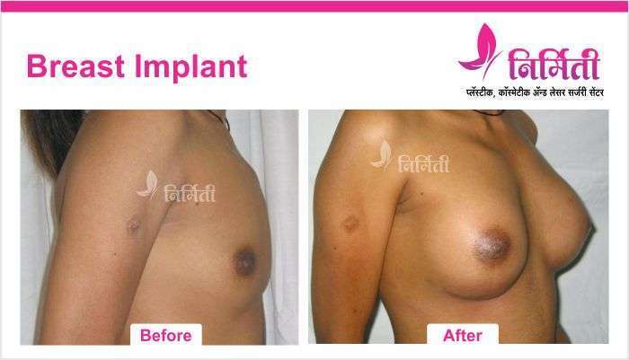 breast-implant-2