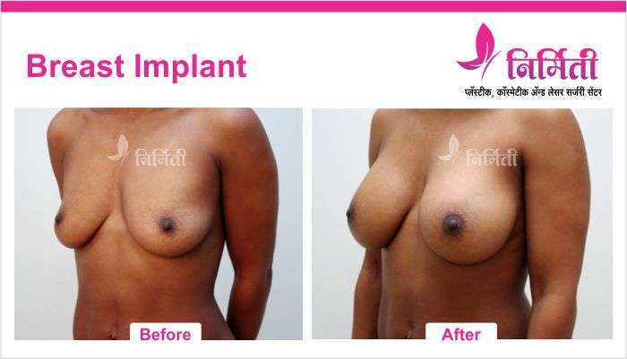 breast-implant-3