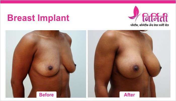 breast-implant-4