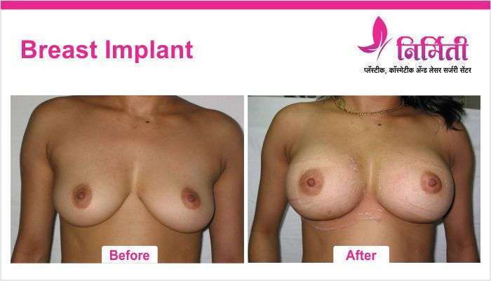 breast-implant-5