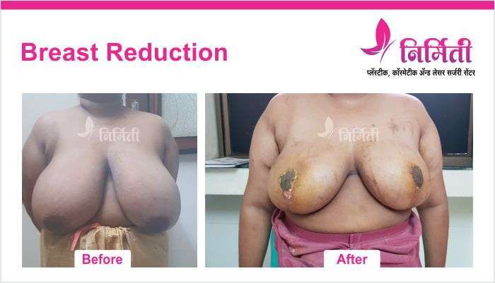 breast-reduction-3