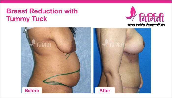breast-reduction-with-tummy-tuck-1