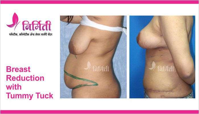 breast-reduction-with-tummy-tuck-3