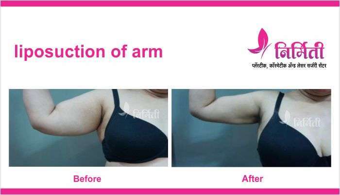 liposuction-of-arm