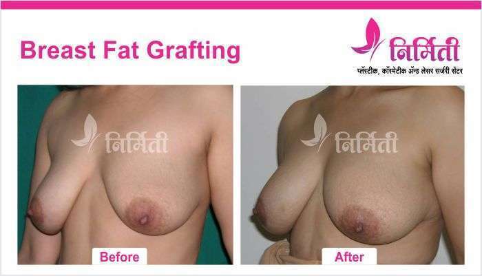 breast-fat-grafting -01