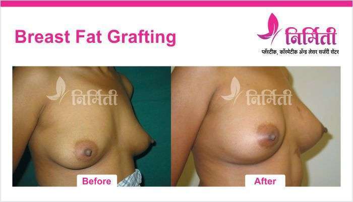 breast-fat-grafting -02