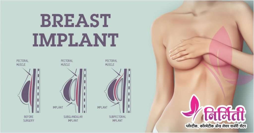 Breast Augmentation Cost: This is What to Expect