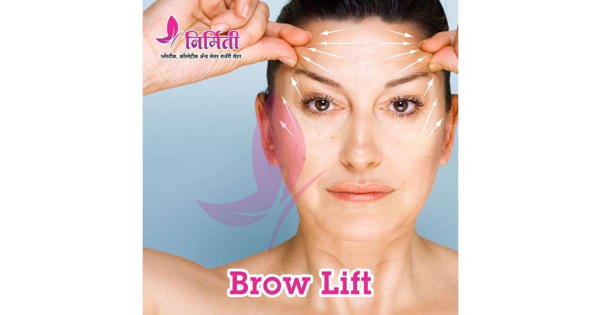 brow-lift-social