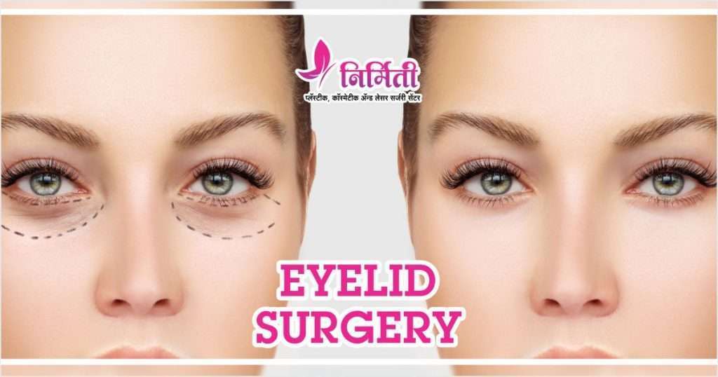 eyelid surgery lift upper without lower face