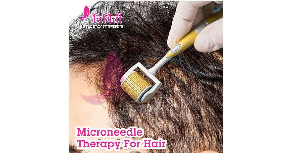 microneedle-therapy-for-hair-social