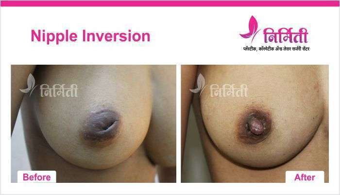nipple-inversion-01