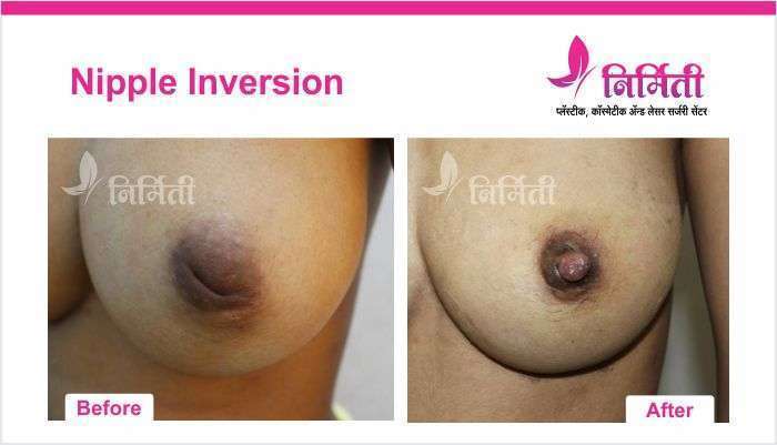 nipple-inversion-02