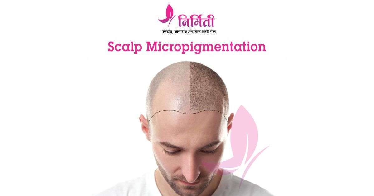 scalp-micropigmentation-social