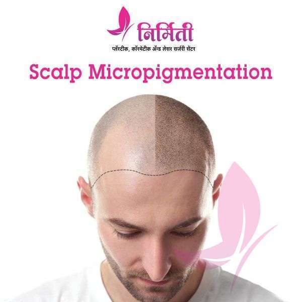 Scalp Micropigmentation Cost in India