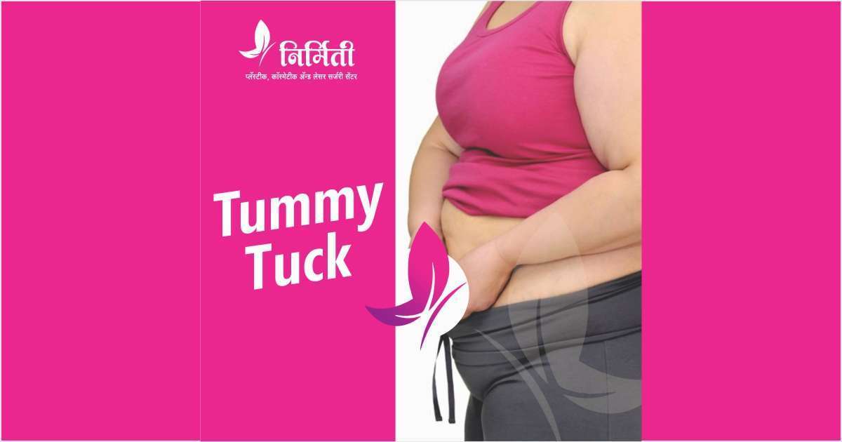 Tummy tuck Surgery Cost Male Tummy Tuck Before and After Near Me