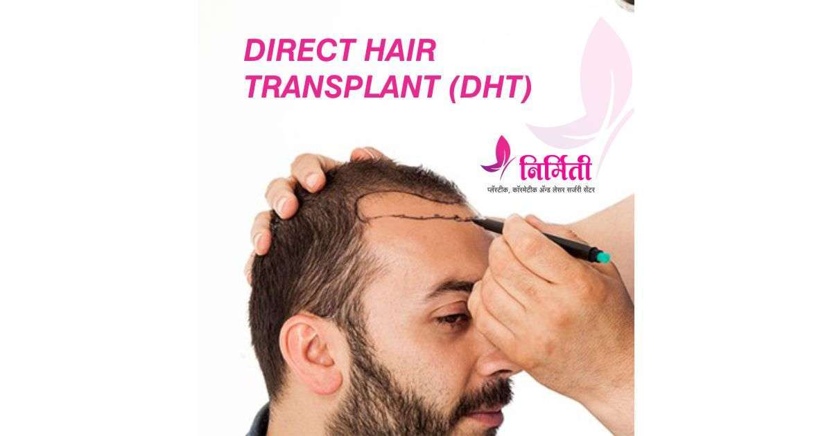 direct-hair-transplant-social