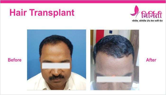 hair-transplant-5