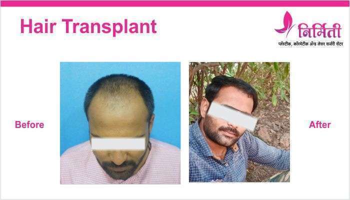 hair-transplant-7