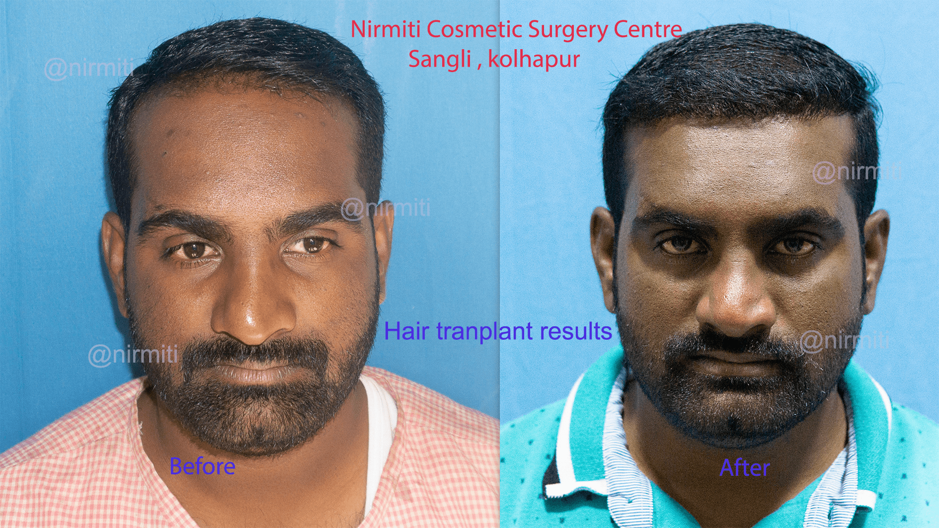 hair transplant pic 1