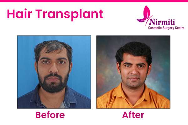 hair-transplant-before-after-image