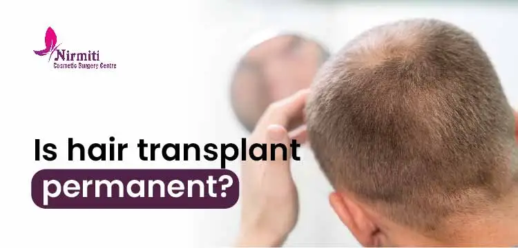 Is Hair Transplant permanent?