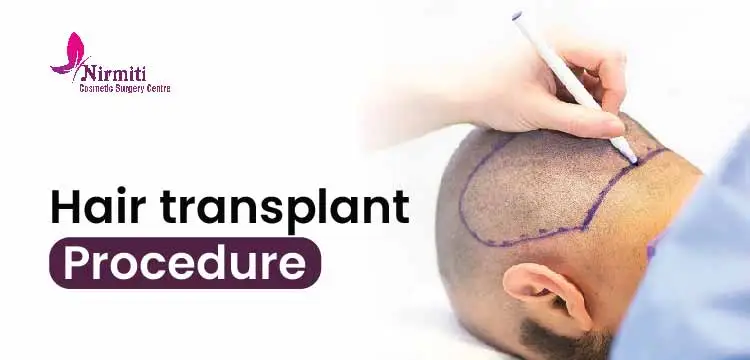 Hair Transplant Procedure