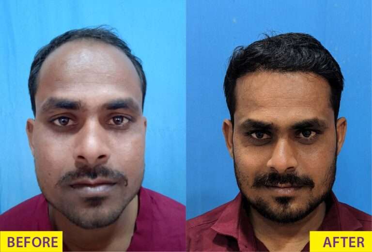 Before and After hair loss procedure