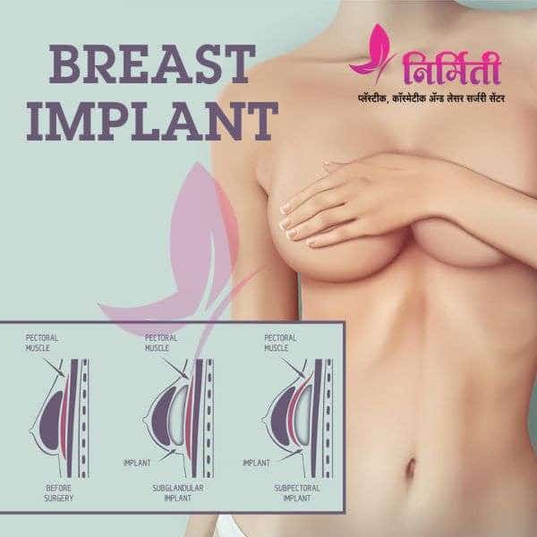 breast-implant