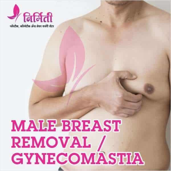 male-breast-removal