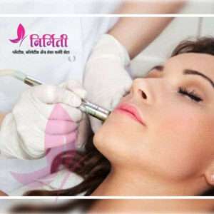 microdermabrasion treatment