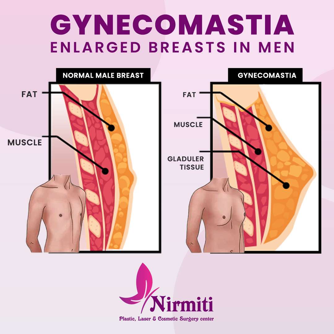 What Causes Male Breasts, Man Boobs or Gynecomastia?