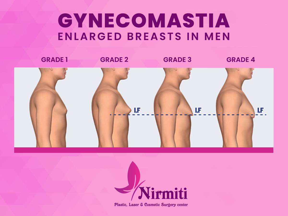 Gynecomastia types