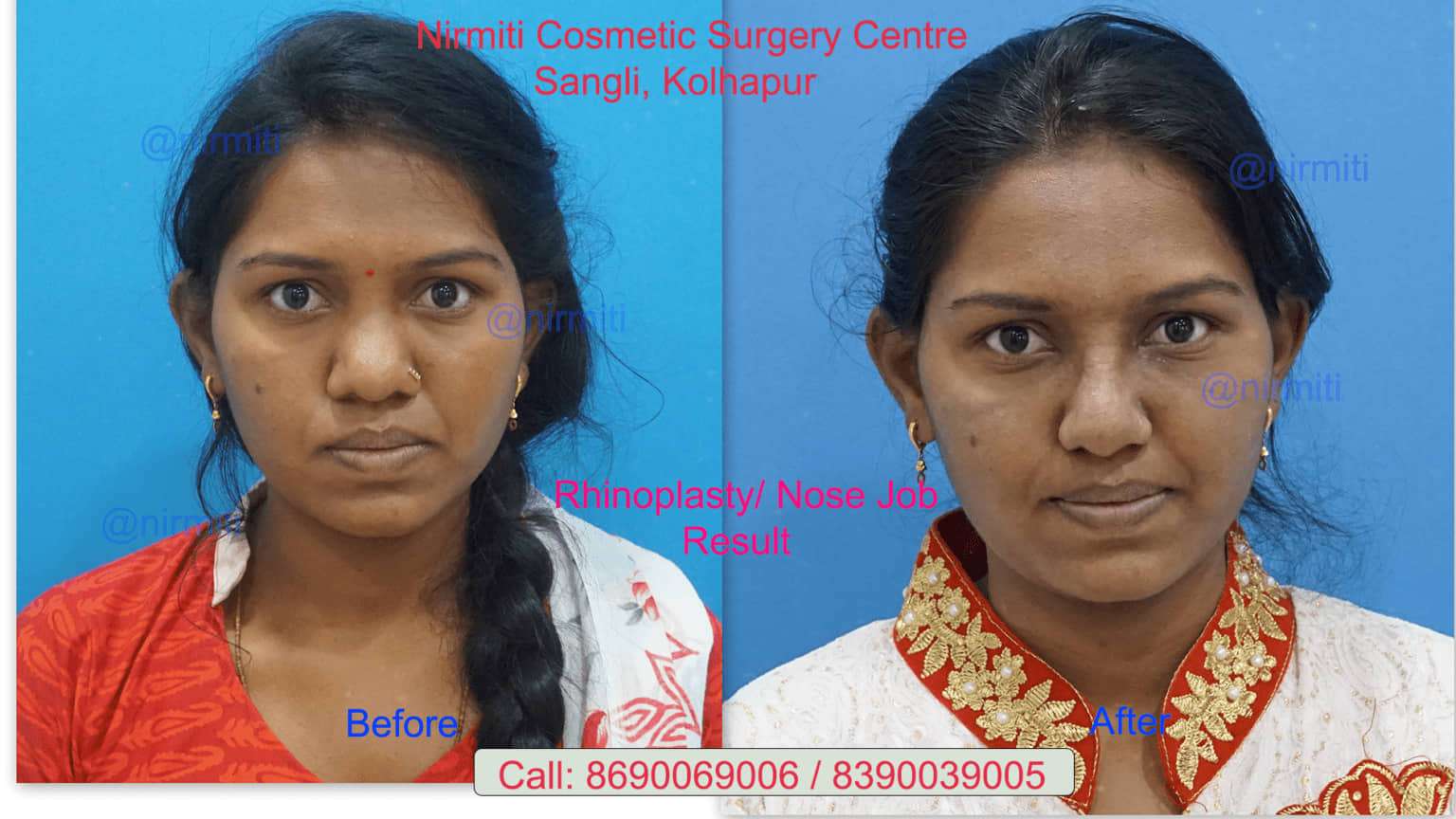 Nose Surgery Patient's results