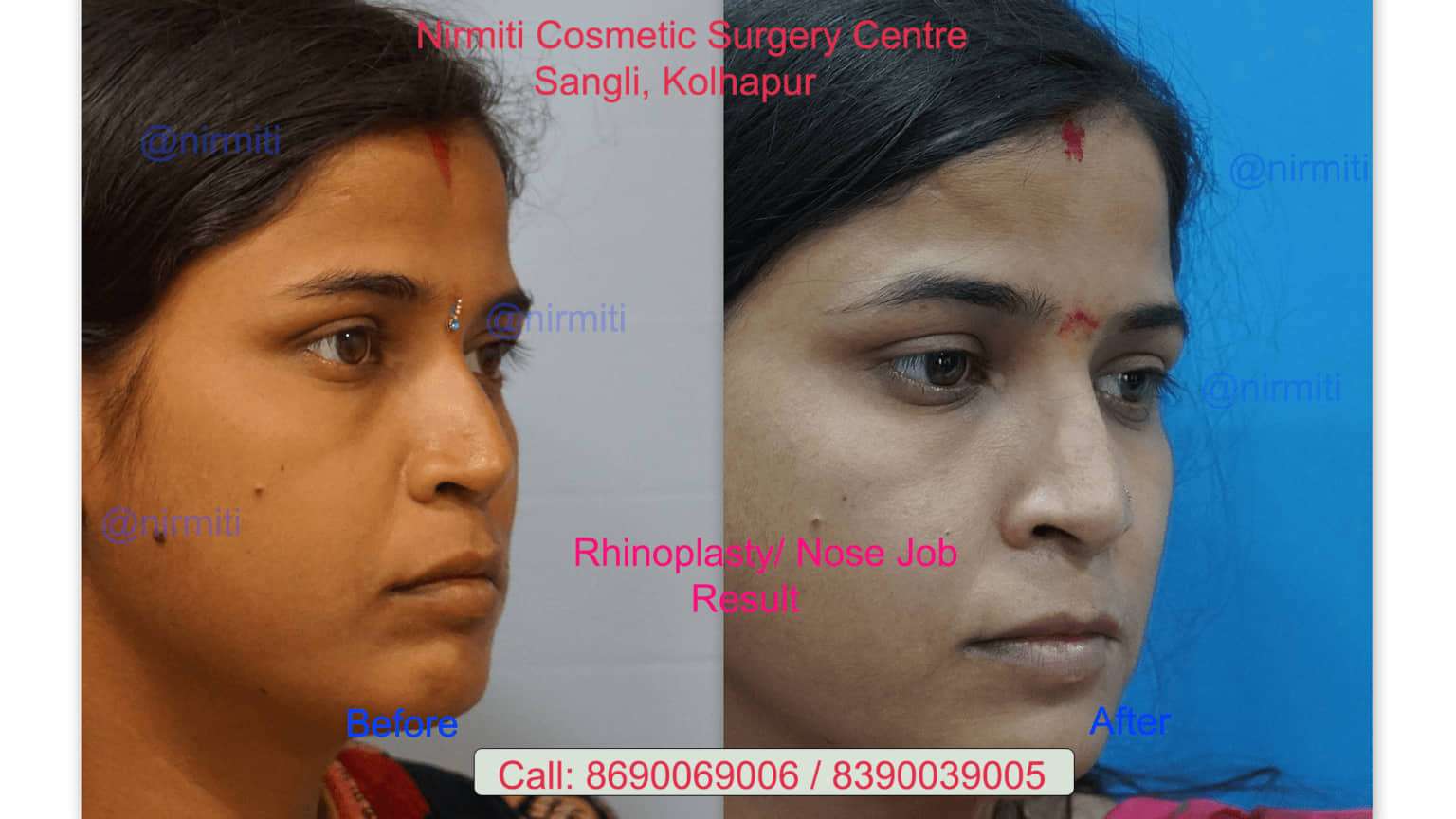 Before & After Results of Nose Job