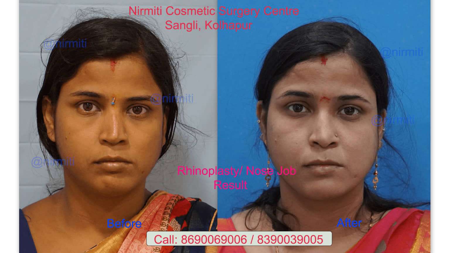 Before & After Results of Rhinoplasty Surgery