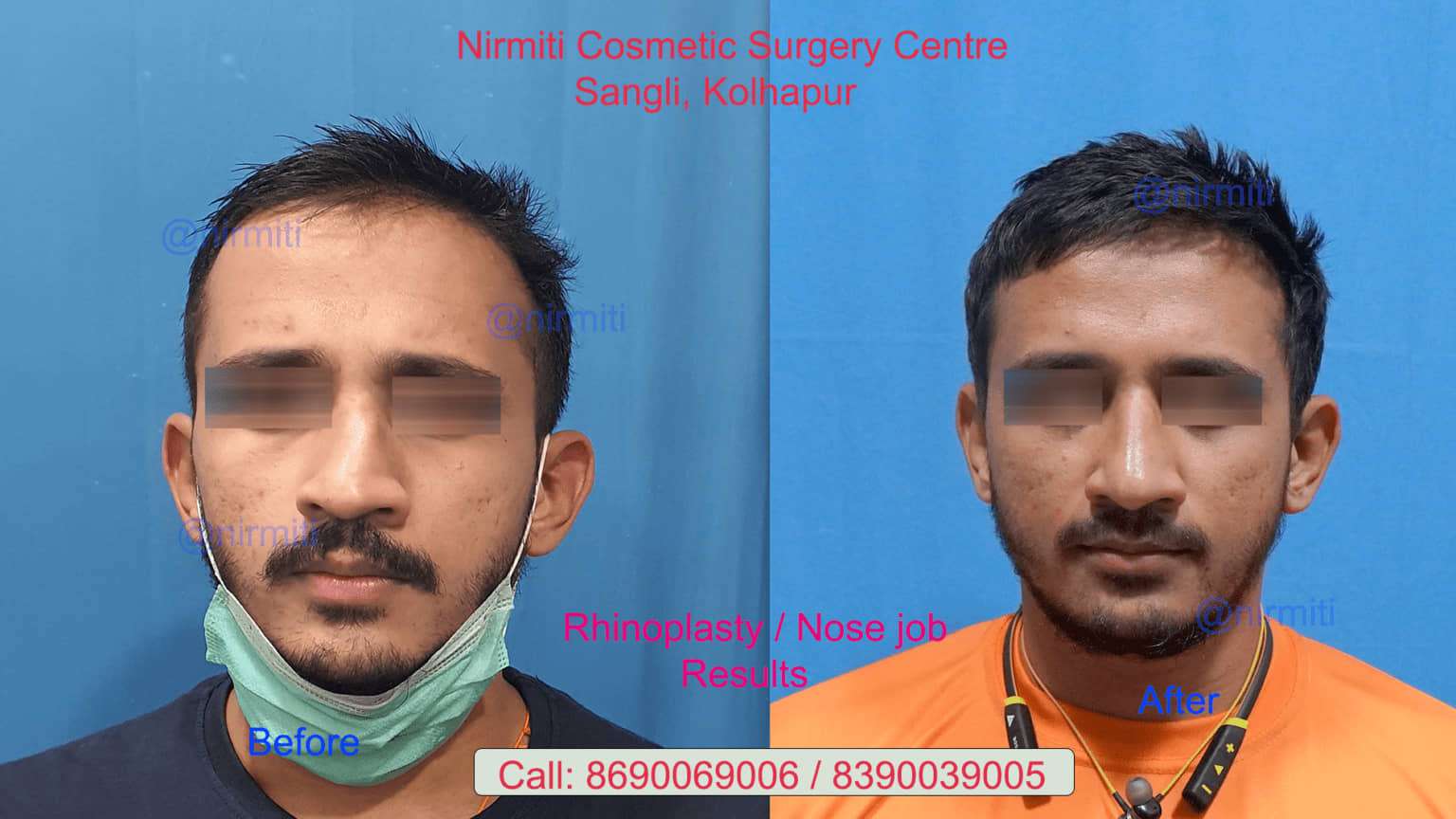Straight Nose Surgery Result
