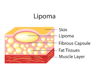 Lipoma