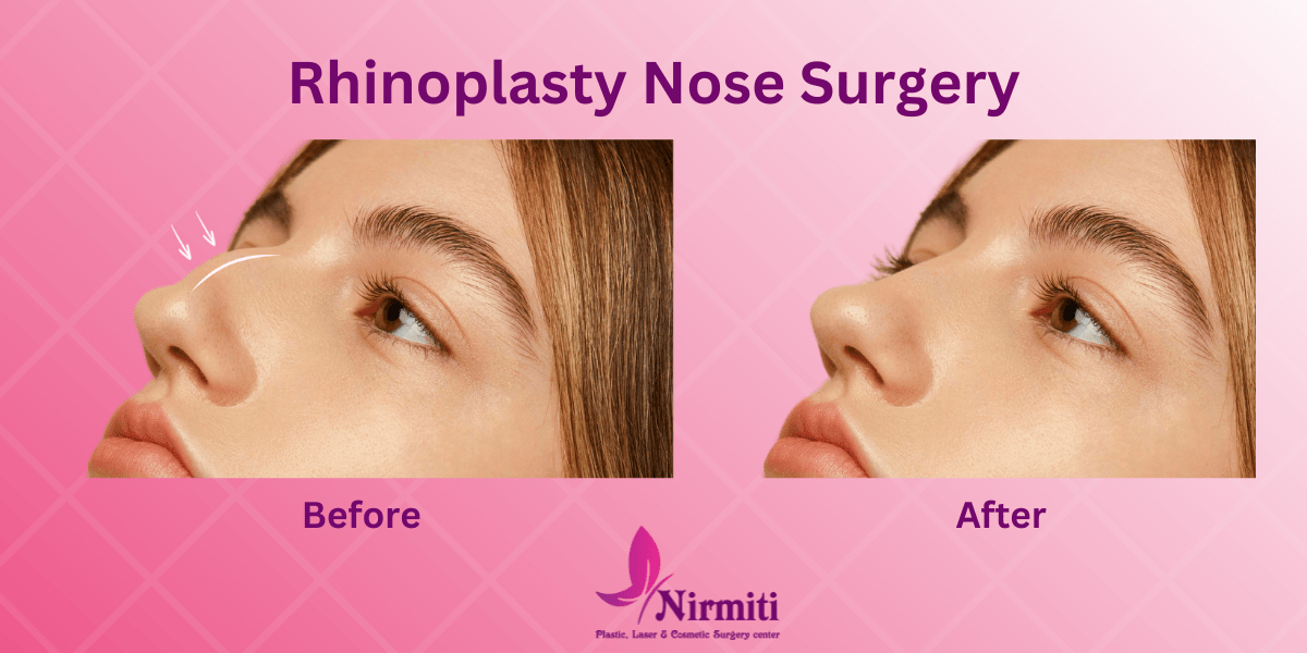 rhinoplasty nose job surgery