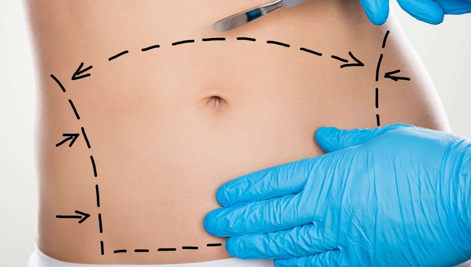 Abdominoplasty Surgery