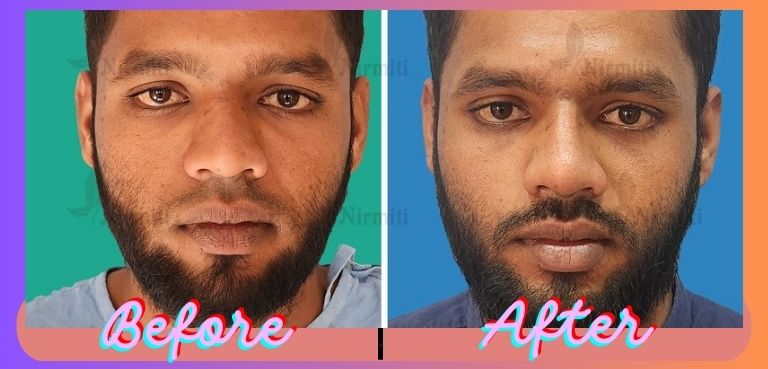 Rhinoplasty Result