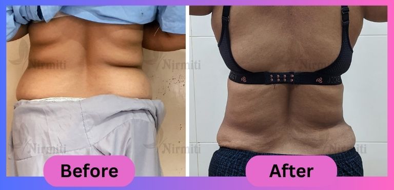 Liposuction Surgery in Sangli