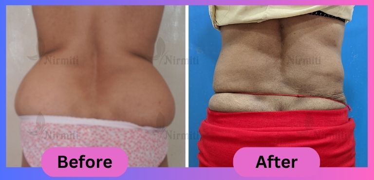 Liposuction Surgery