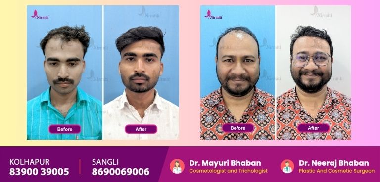 Best Hair Transplant