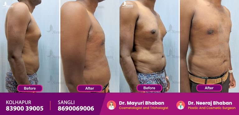 Gynecomastia Surgery